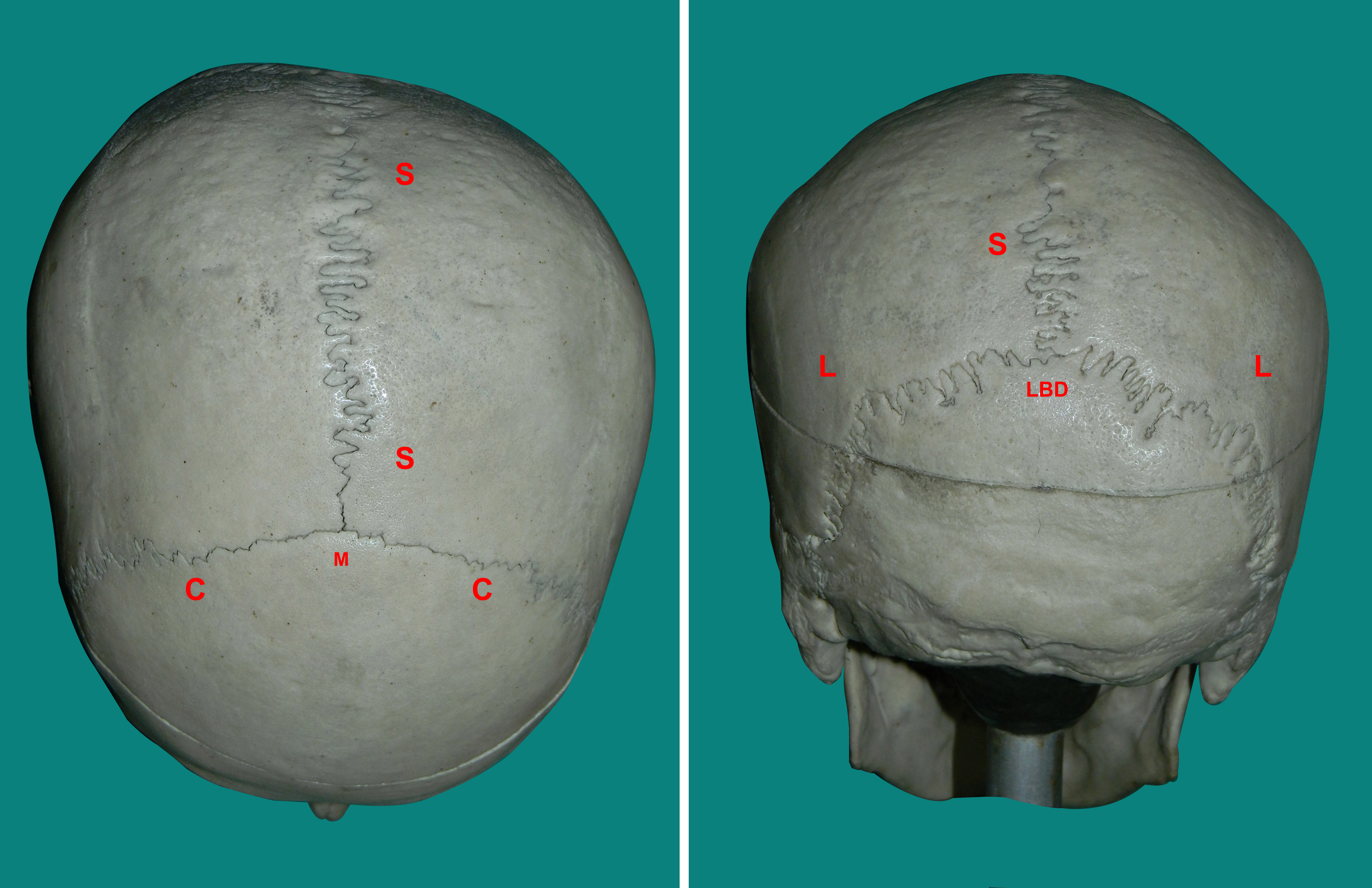 Frontal Suture Closure