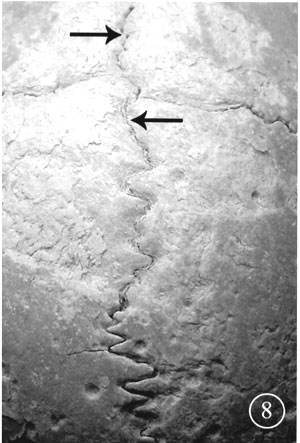 When Does Frontal Suture Closure