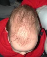 When Does Frontal Suture Closure