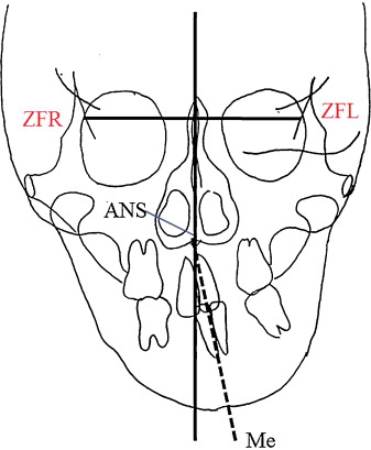 Zygomatic Frontal Suture